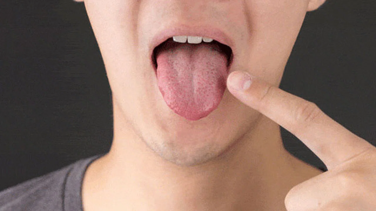 Dilde kıllanma ile nasıl mücadele edilir?