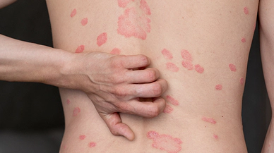 Zona, Kökten Ele Alınması Gereken Bir Sağlık Sorunu