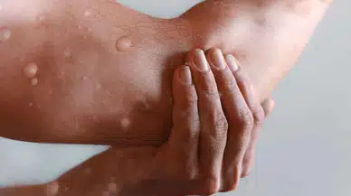 Maymun Çiçeği Hastalığına Dair 11 Önemli Soru ve Cevaplar