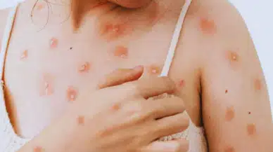 Türkiye’de İlk Maymun Çiçeği Vakası Şüphesi