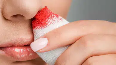 Burun Kanamaları, Nedenleri ve Tedavi Yöntemleri